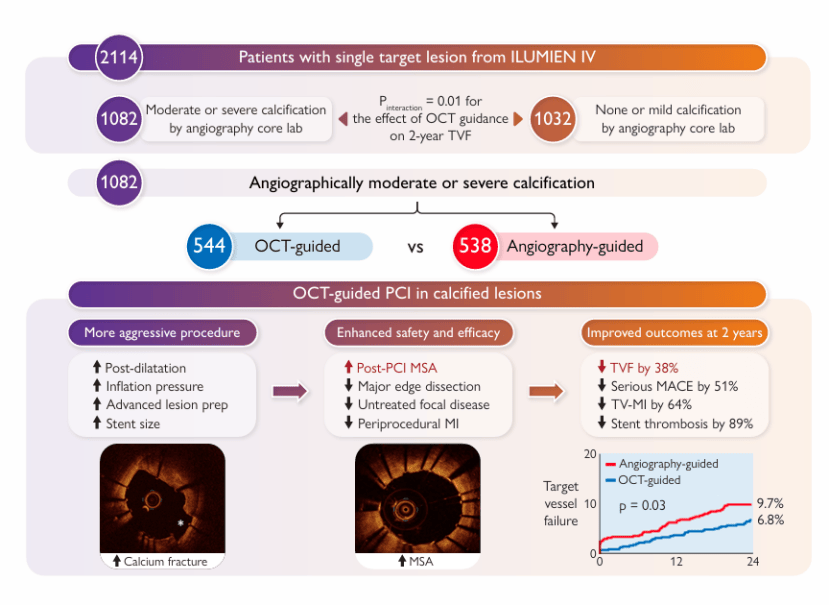 中或重度钙化病变，OCT指导PCI效果佳！ILUMIEN IV研究亚组分析