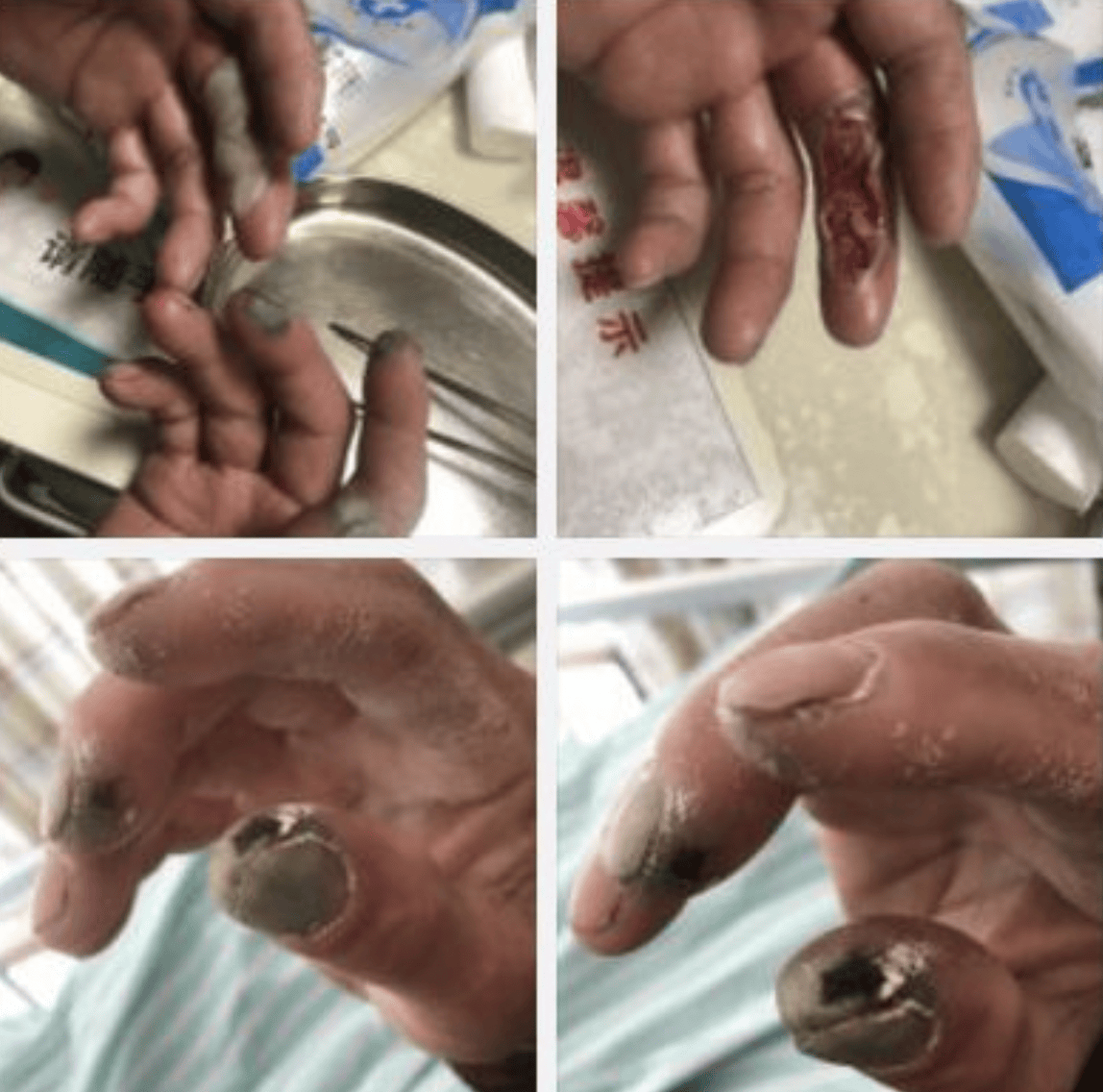 杭州女子接触氢氟酸中毒身亡，警方介入！曾有环卫工手遭腐蚀